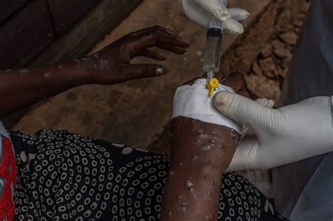 Africa's mpox outbreaks result from neglect and world's inability to .